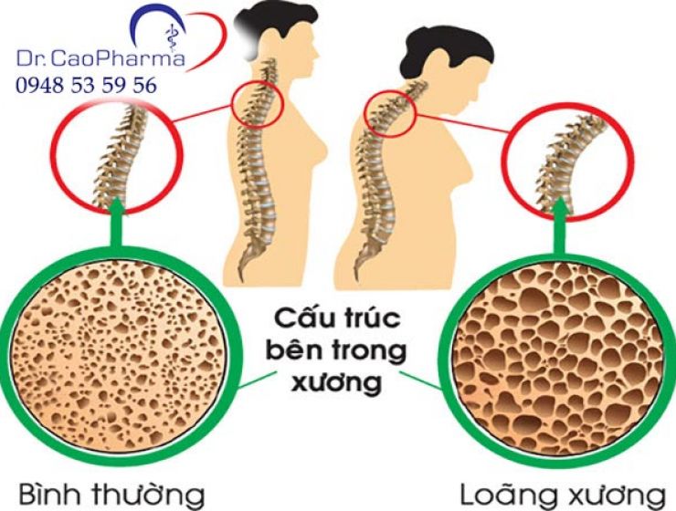 Bệnh loãng xương có chữa được không? Cách điều trị hiệu quả