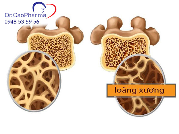 Khi bị loãng xương người bệnh thường bị đau nhức xương khớp thường xuyên