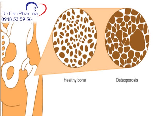 Dấu hiệu về bệnh loãng xương