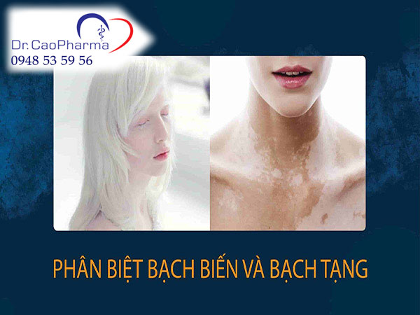 Bệnh bạch tạng và bệnh bạch biến có gì khác nhau?